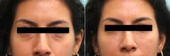 Before and after Cheeks / Midface Injections by Dr. Shervin Naderi, Patient 16311