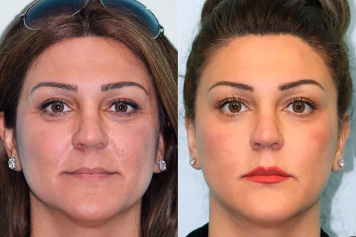 Before and after Cheeks / Midface Injections by Dr. Shervin Naderi, Patient 17106