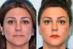 Before and after Cheeks / Midface Injections by Dr. Shervin Naderi, Patient 17106