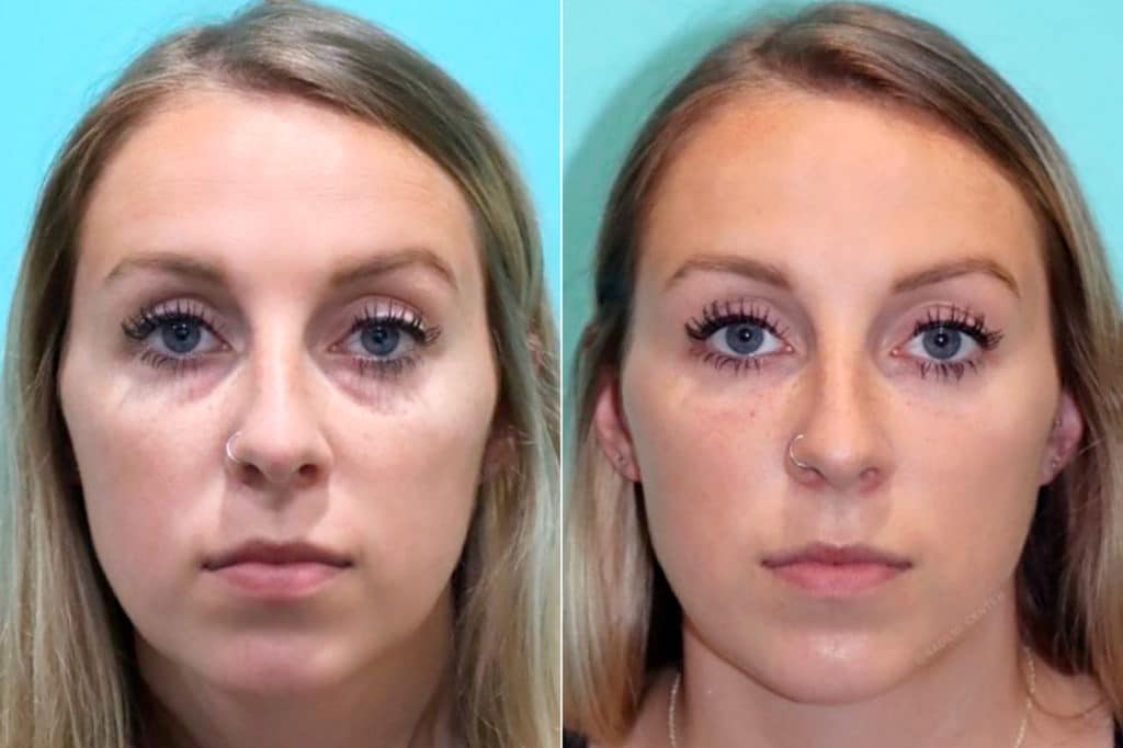 Tear Trough / Under Eye Injections before and after photos Page 2 of