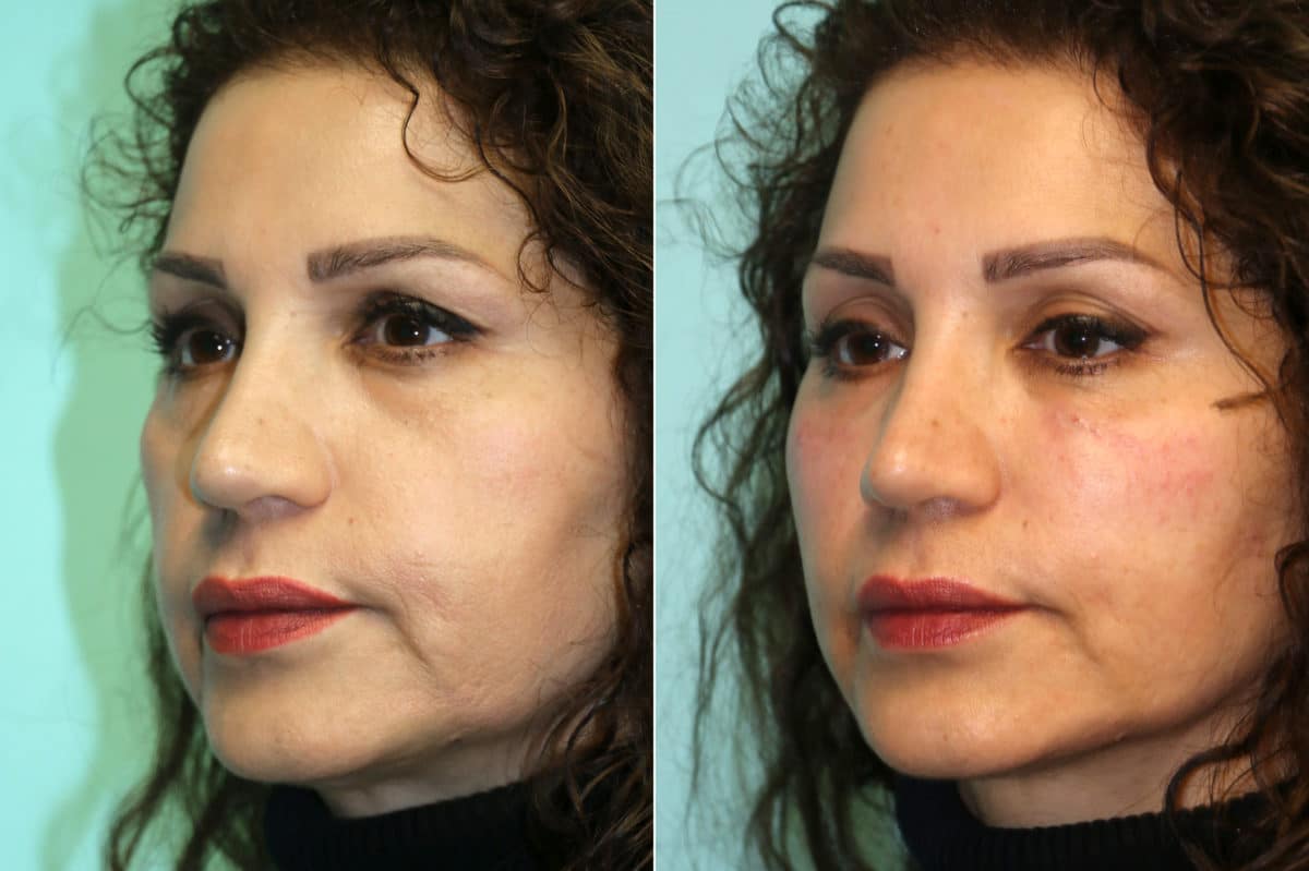 Before and after Cheeks / Midface Injections by Dr. Shervin Naderi, Patient 17226