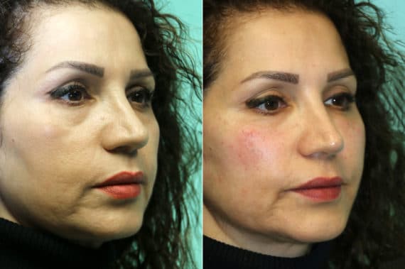 Before and after Cheeks / Midface Injections by Dr. Shervin Naderi, Patient 17226