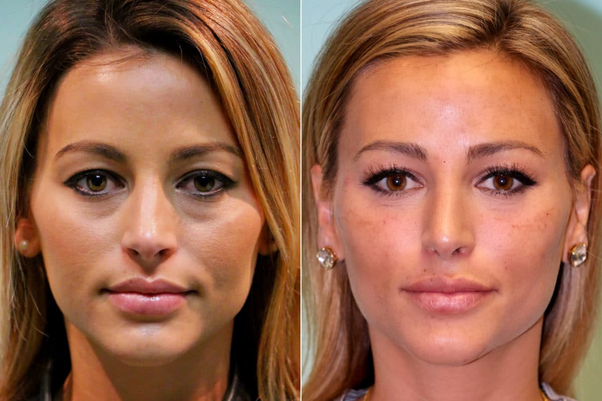 Patient 17406, Injections Before and After Photos Before and after Injections by Dr. Shervin Naderi, Patient 17406