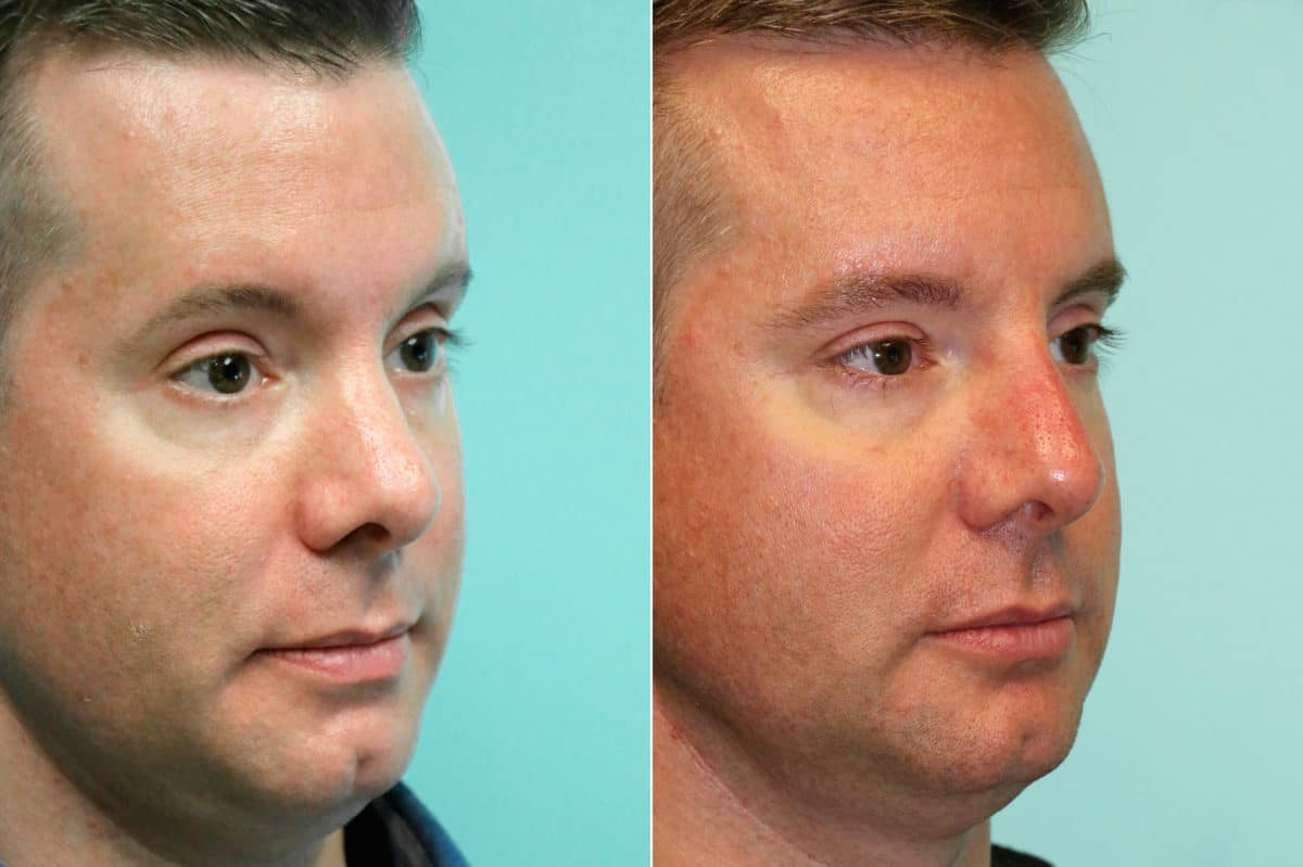 Before and after Non-Surgical Rhinoplasty by Dr. Shervin Naderi, Patient 18613