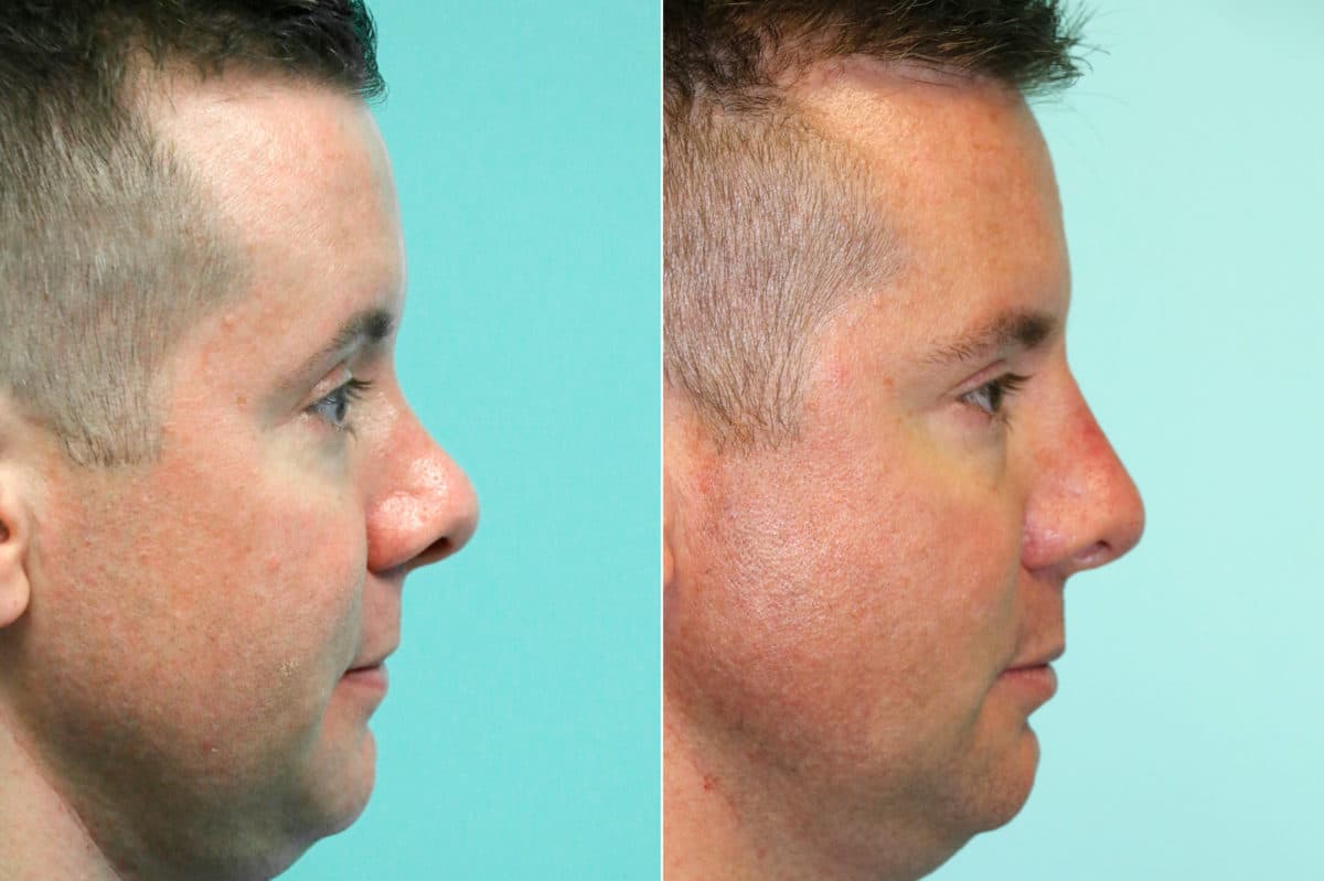 Before and after Non-Surgical Rhinoplasty by Dr. Shervin Naderi, Patient 18613