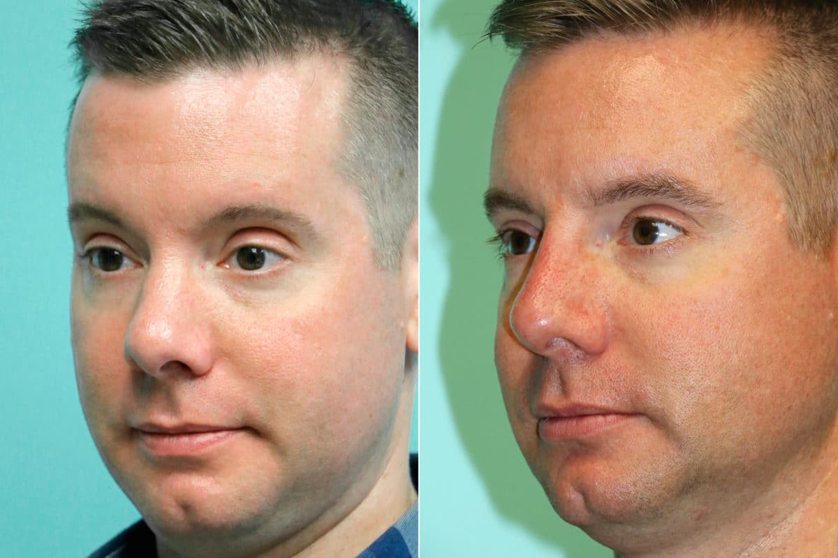 Before and after Non-Surgical Rhinoplasty by Dr. Shervin Naderi, Patient 18613