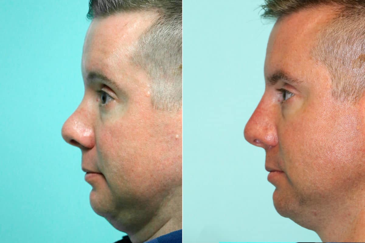 Before and after Non-Surgical Rhinoplasty by Dr. Shervin Naderi, Patient 18613