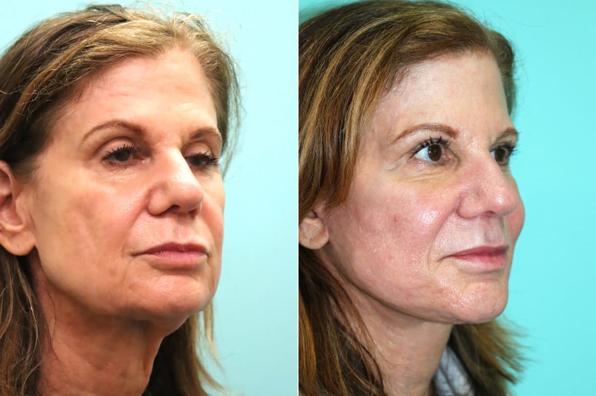 Before and after Facelift by Dr. Shervin Naderi, Patient 18641