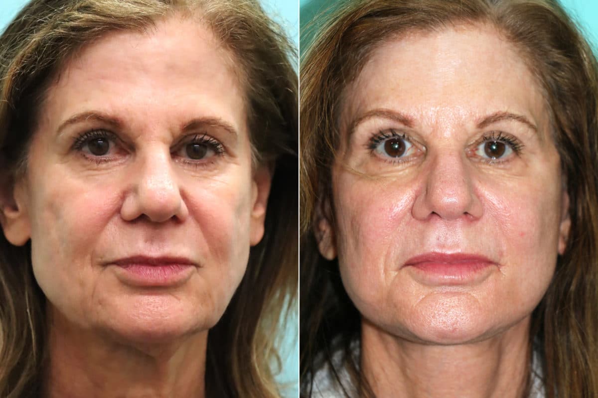 Before and after Facelift by Dr. Shervin Naderi, Patient 18641