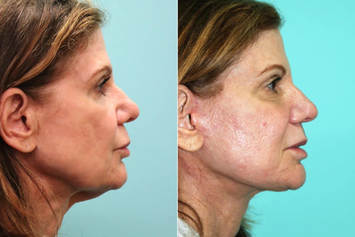 Before and after Facelift by Dr. Shervin Naderi, Patient 18641