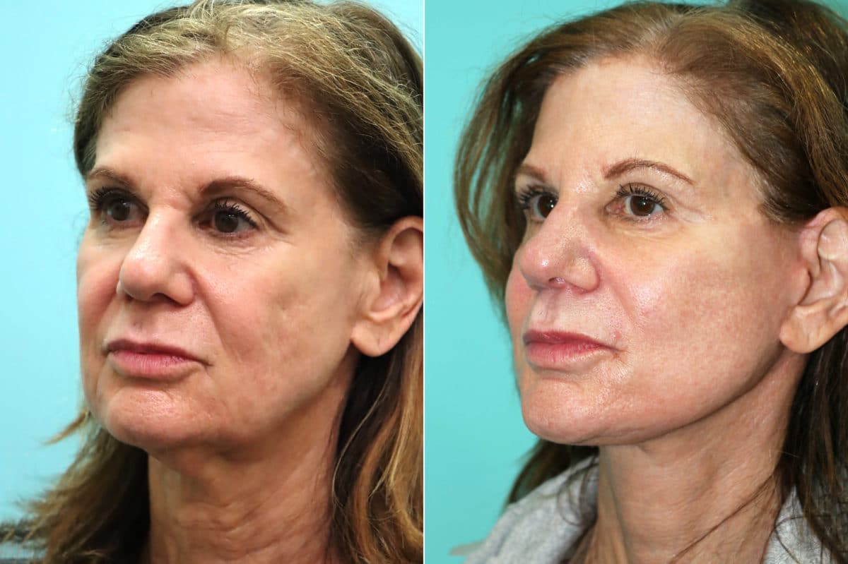 Before and after Facelift by Dr. Shervin Naderi, Patient 18641