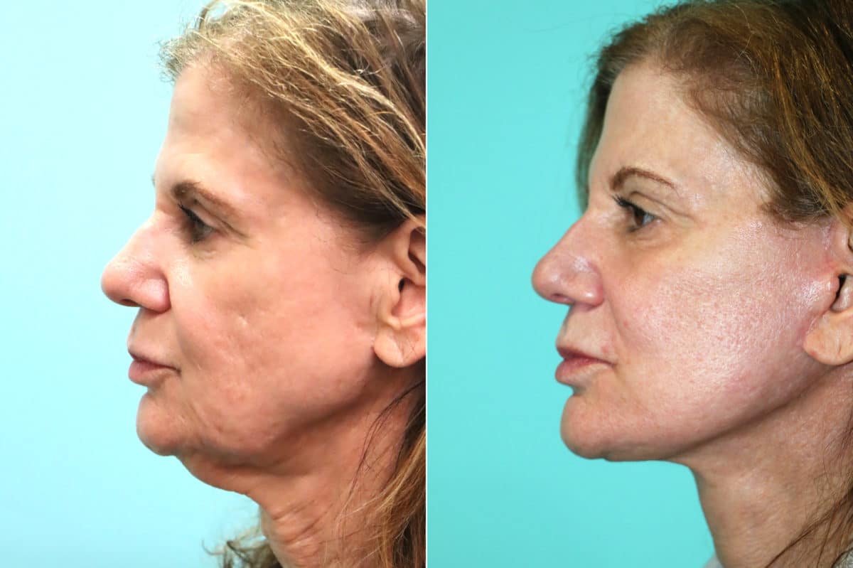 Before and after Facelift by Dr. Shervin Naderi, Patient 18641