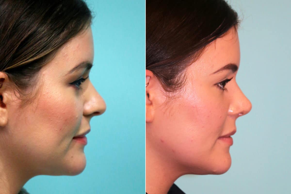 Before and after Rhinoplasty by Dr. Shervin Naderi, Patient 18678