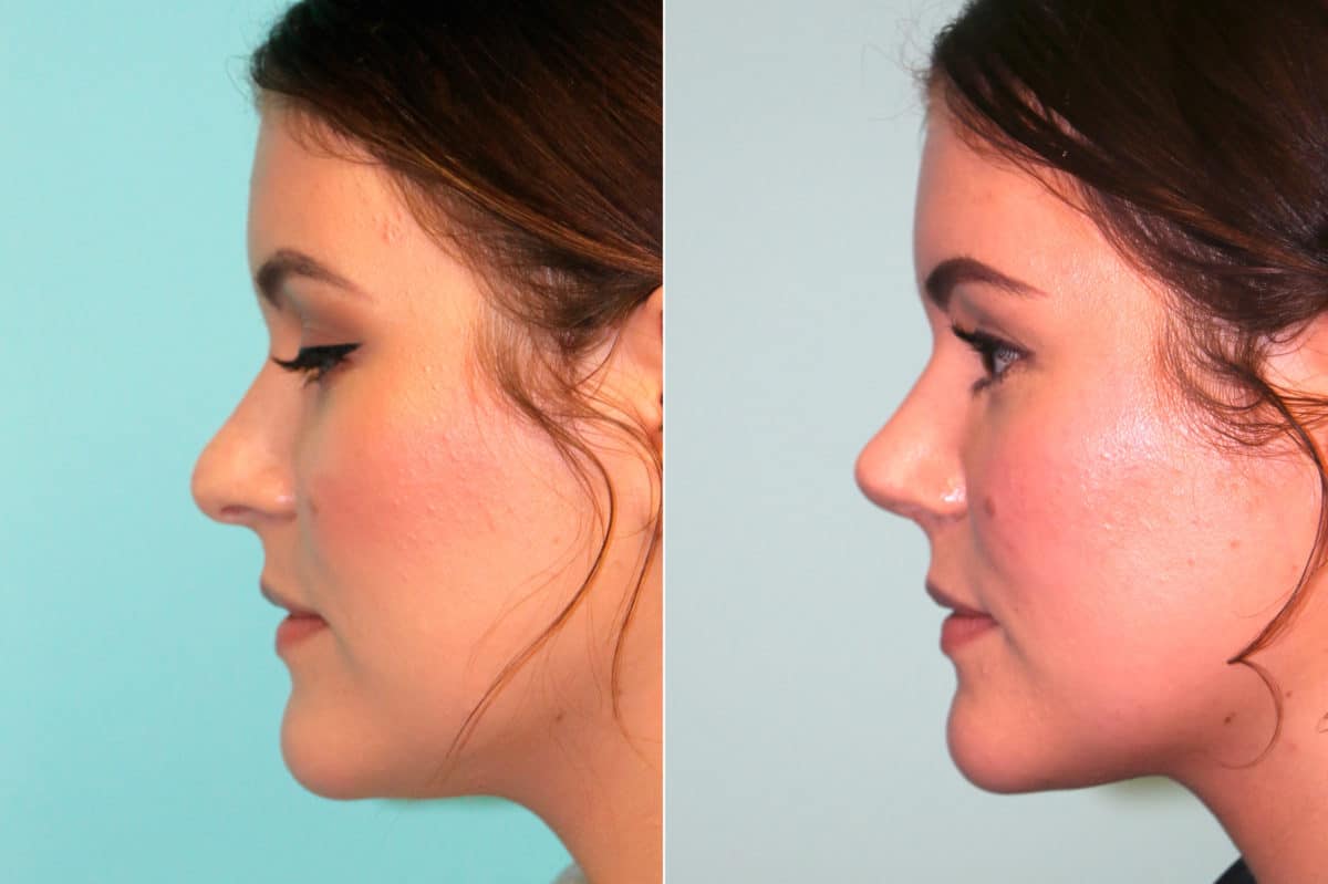 Before and after Rhinoplasty by Dr. Shervin Naderi, Patient 18678