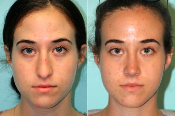 Before and after Rhinoplasty by Dr. Shervin Naderi, Patient 18737