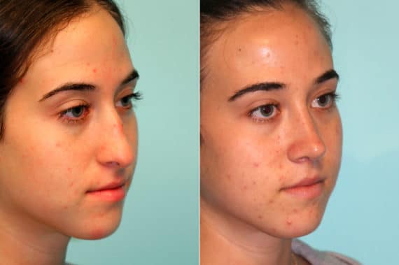 Before and after Rhinoplasty by Dr. Shervin Naderi, Patient 18737