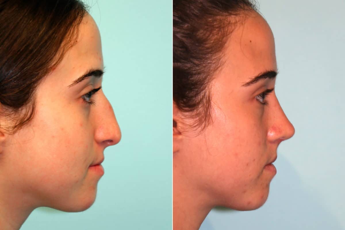 Before and after Rhinoplasty by Dr. Shervin Naderi, Patient 18737