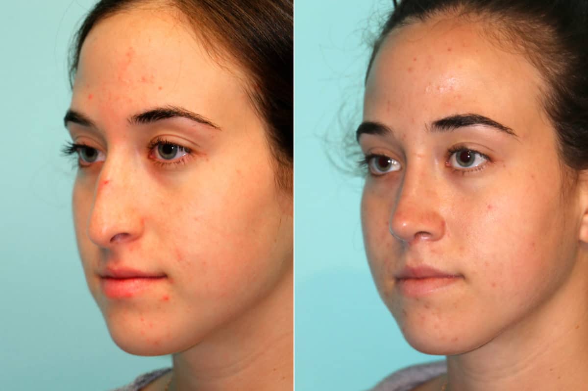 Before and after Rhinoplasty by Dr. Shervin Naderi, Patient 18737