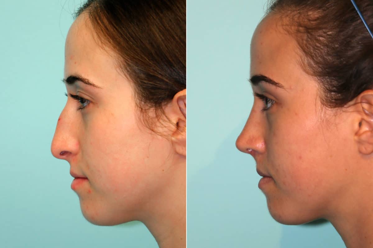 Before and after Rhinoplasty by Dr. Shervin Naderi, Patient 18737