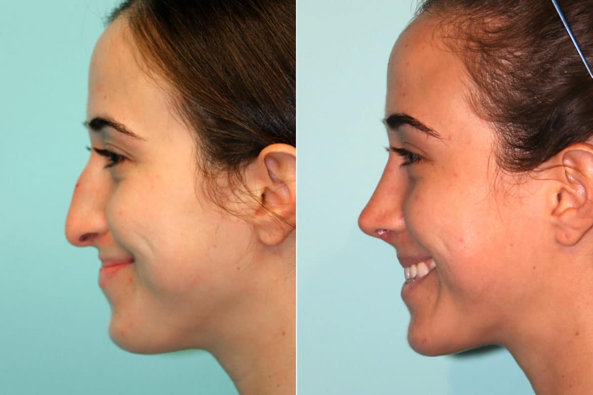 Before and after Rhinoplasty by Dr. Shervin Naderi, Patient 18737