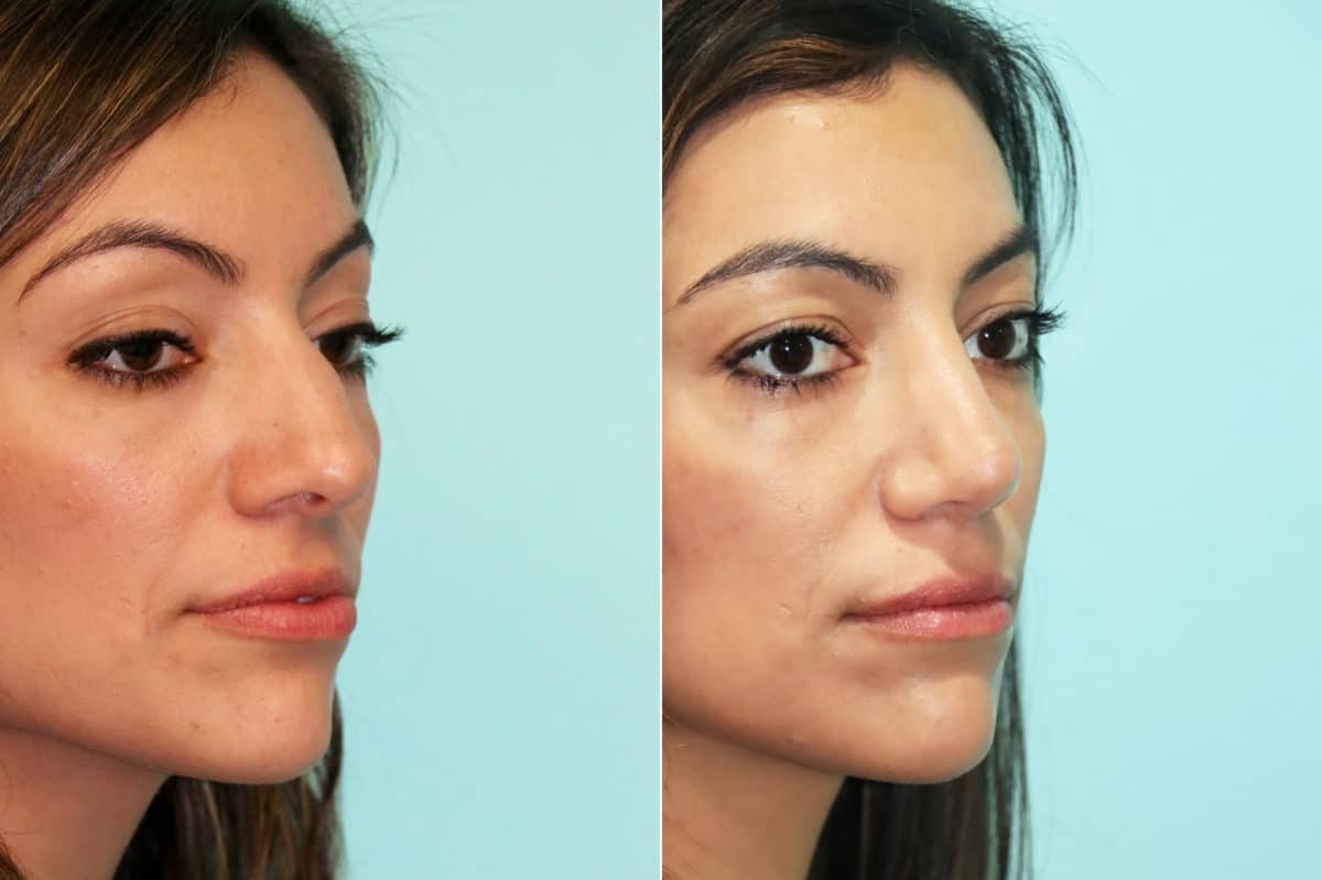 Before and after Non-Surgical Rhinoplasty by Dr. Shervin Naderi, Patient 18779