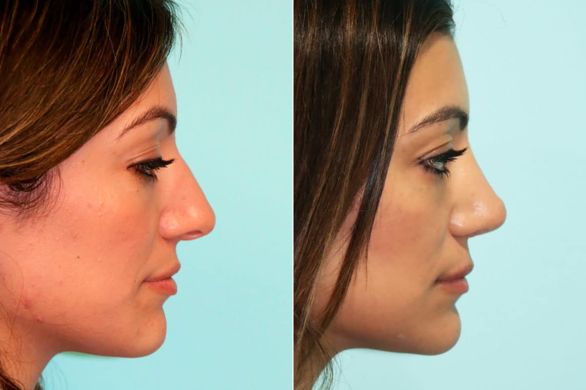 Before and after Non-Surgical Rhinoplasty by Dr. Shervin Naderi, Patient 18779