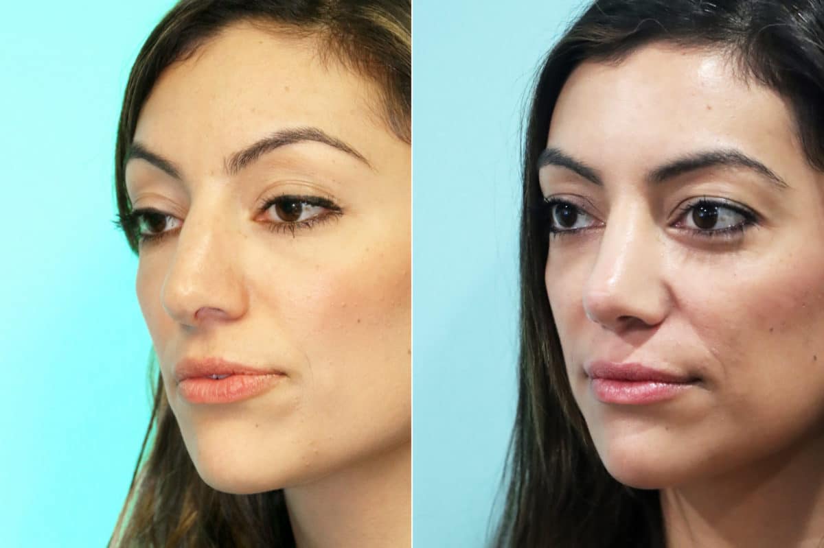 Before and after Non-Surgical Rhinoplasty by Dr. Shervin Naderi, Patient 18779