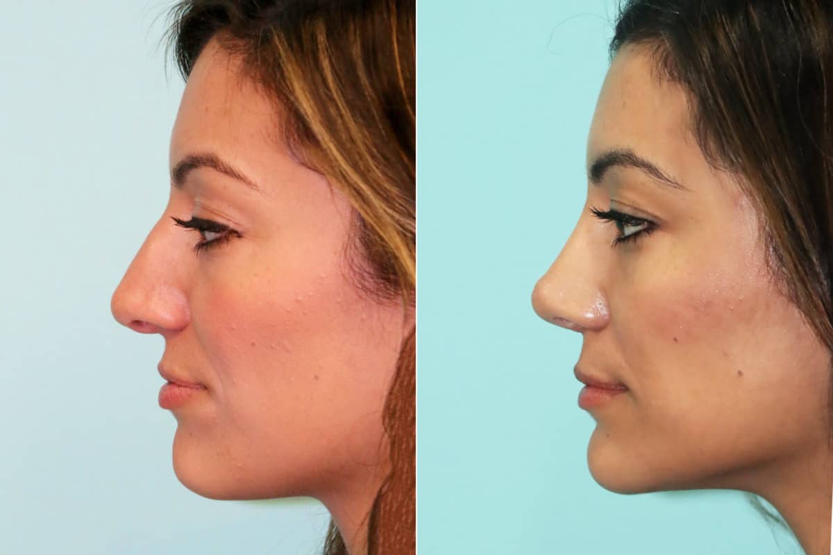 Before and after Non-Surgical Rhinoplasty by Dr. Shervin Naderi, Patient 18779