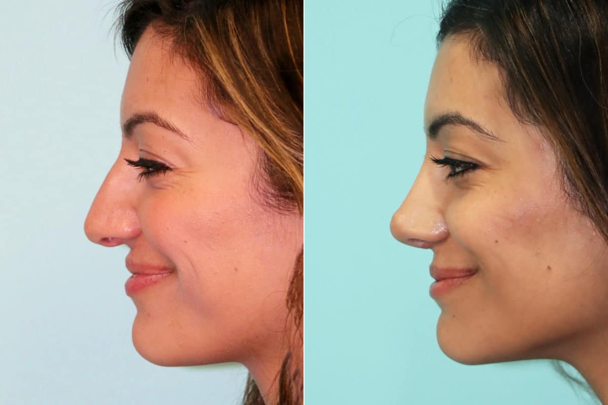 Before and after Non-Surgical Rhinoplasty by Dr. Shervin Naderi, Patient 18779