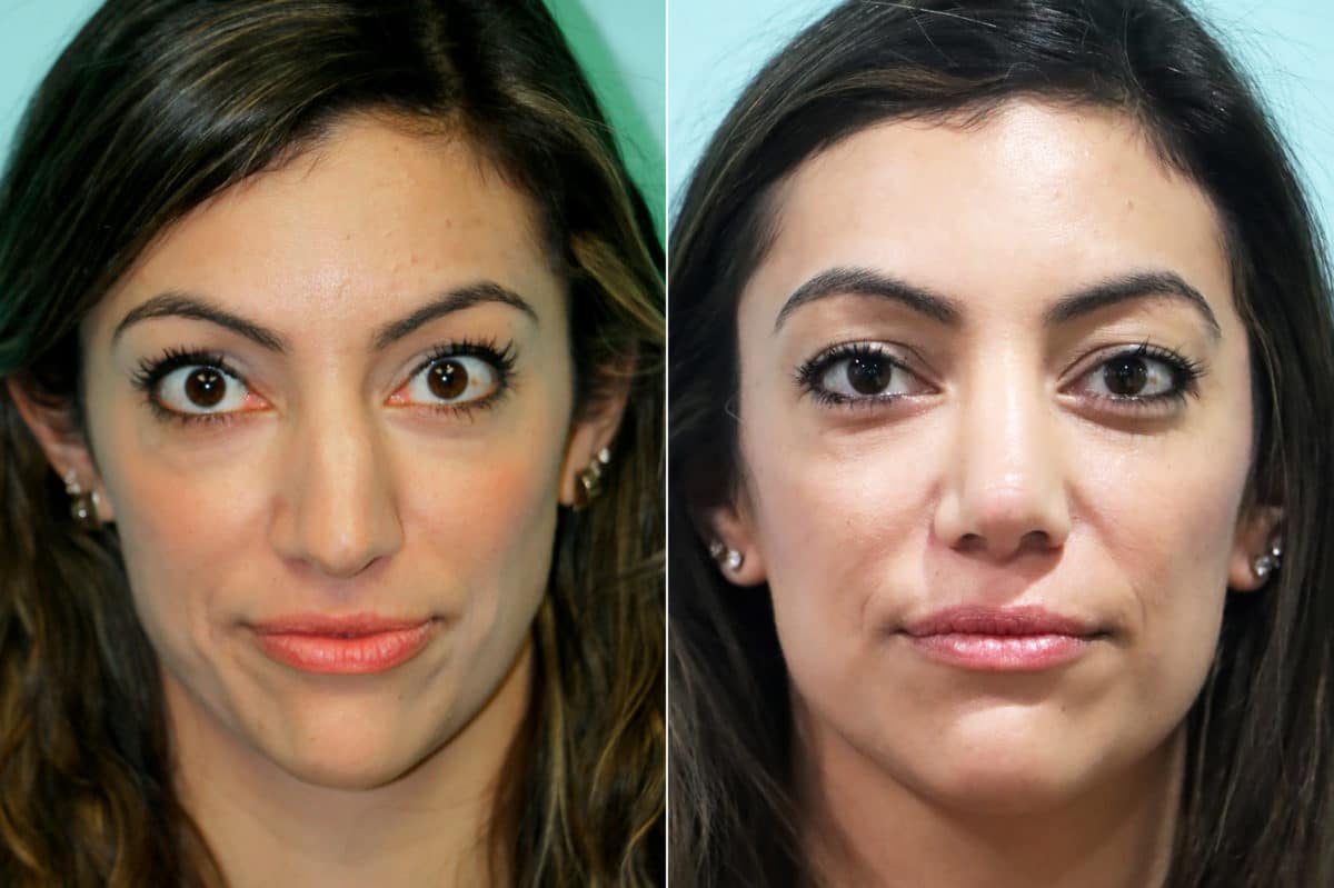 Before and after Non-Surgical Rhinoplasty by Dr. Shervin Naderi, Patient 18779