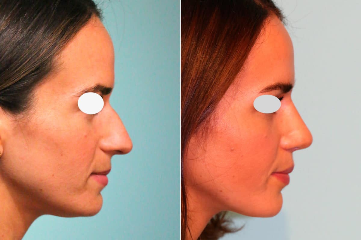 Before and after Non-Surgical Rhinoplasty by Dr. Shervin Naderi, Patient 18873