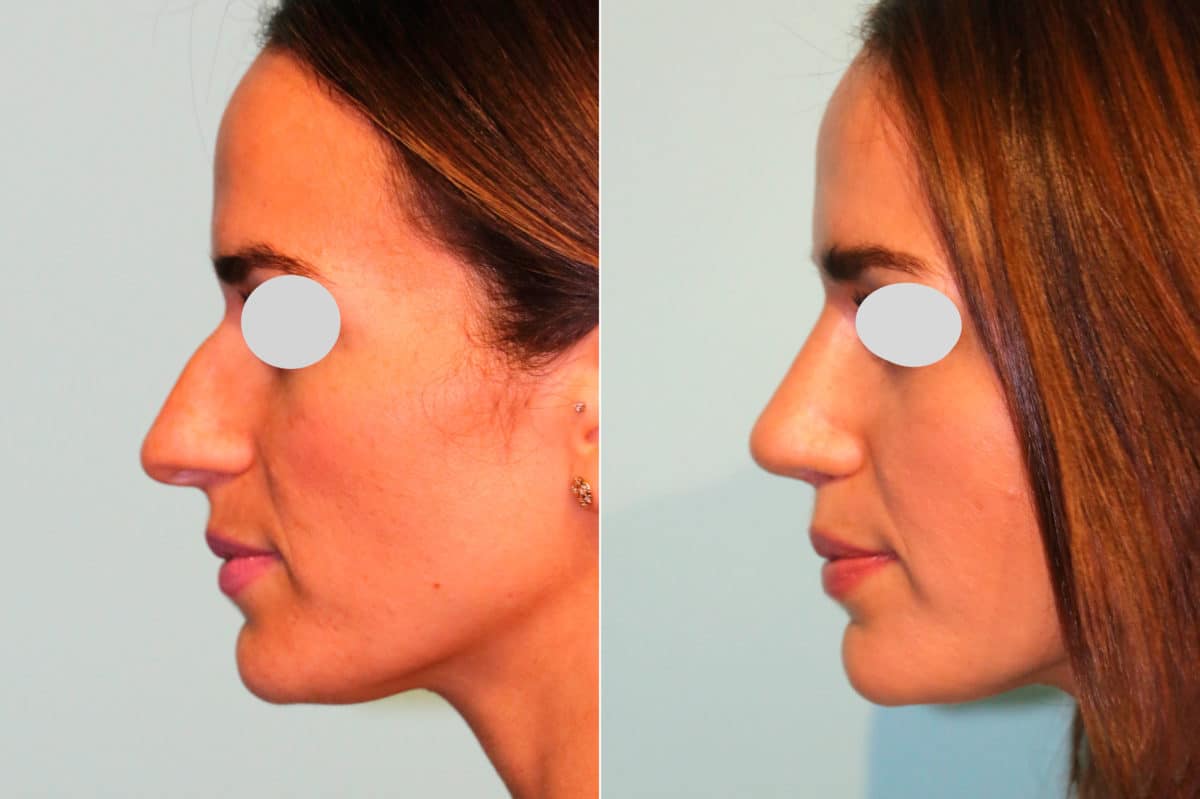 Before and after Non-Surgical Rhinoplasty by Dr. Shervin Naderi, Patient 18873