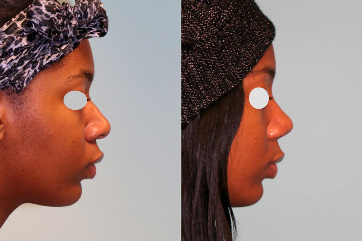 Before and after Rhinoplasty by Dr. Shervin Naderi, Patient 18892