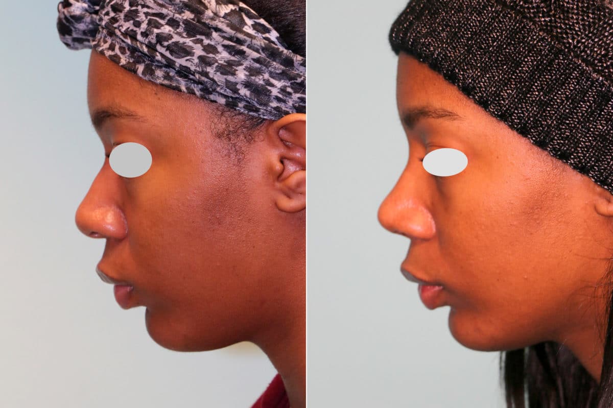 Before and after Rhinoplasty by Dr. Shervin Naderi, Patient 18892