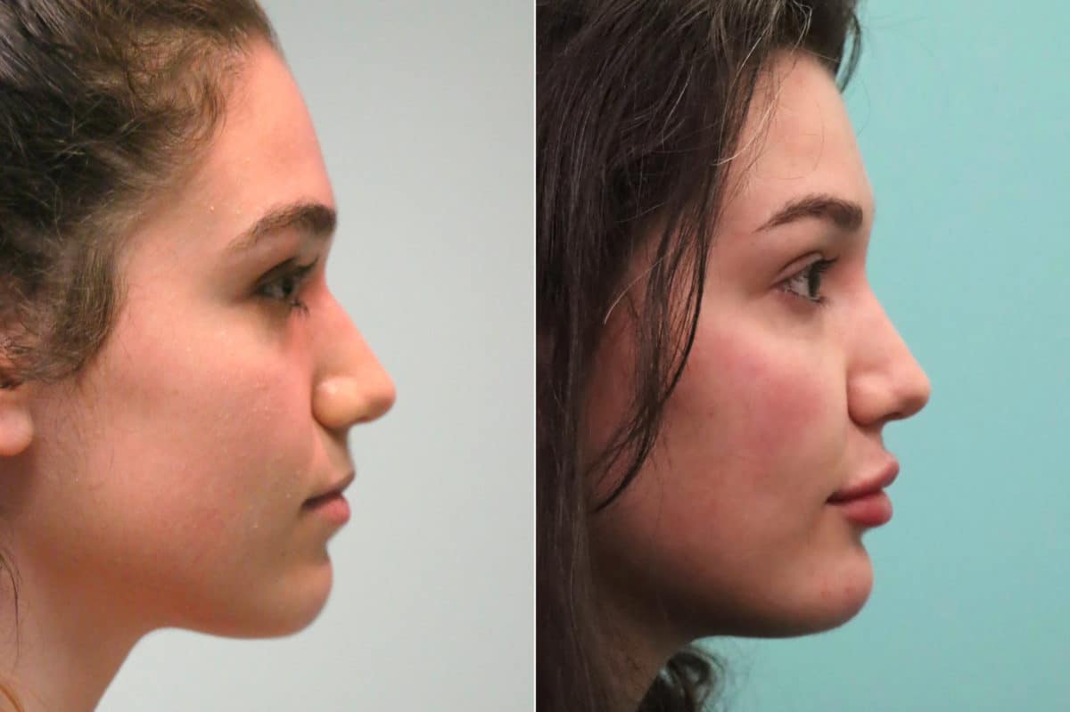 Before and after Cheeks / Midface Injections by Dr. Shervin Naderi, Patient 18935