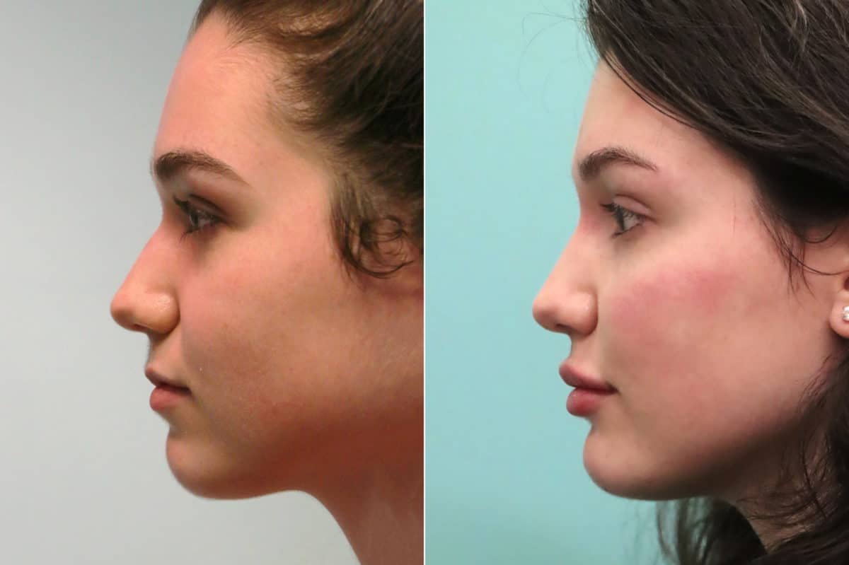 Before and after Cheeks / Midface Injections by Dr. Shervin Naderi, Patient 18935