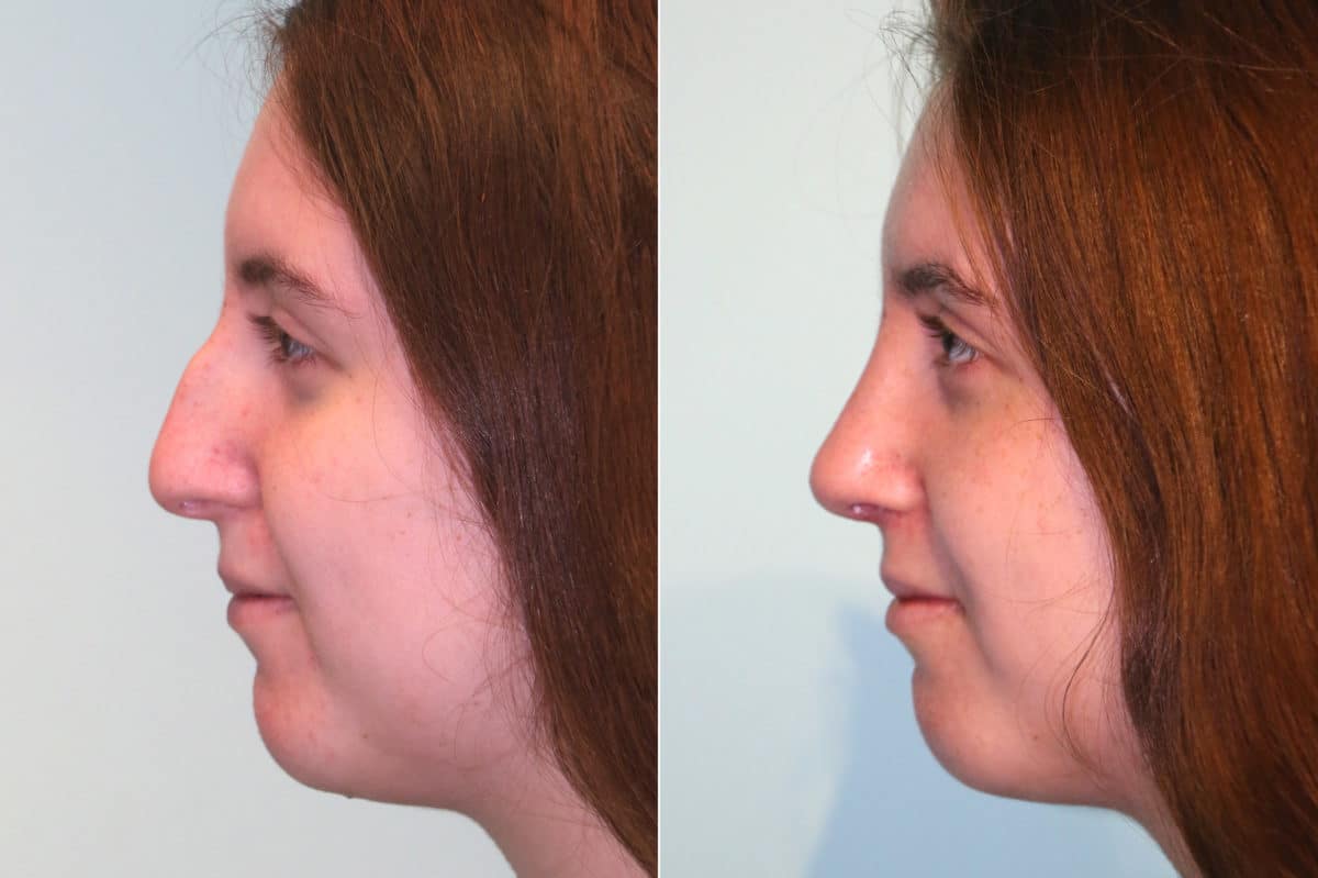 Before and after Rhinoplasty by Dr. Shervin Naderi, Patient 18958