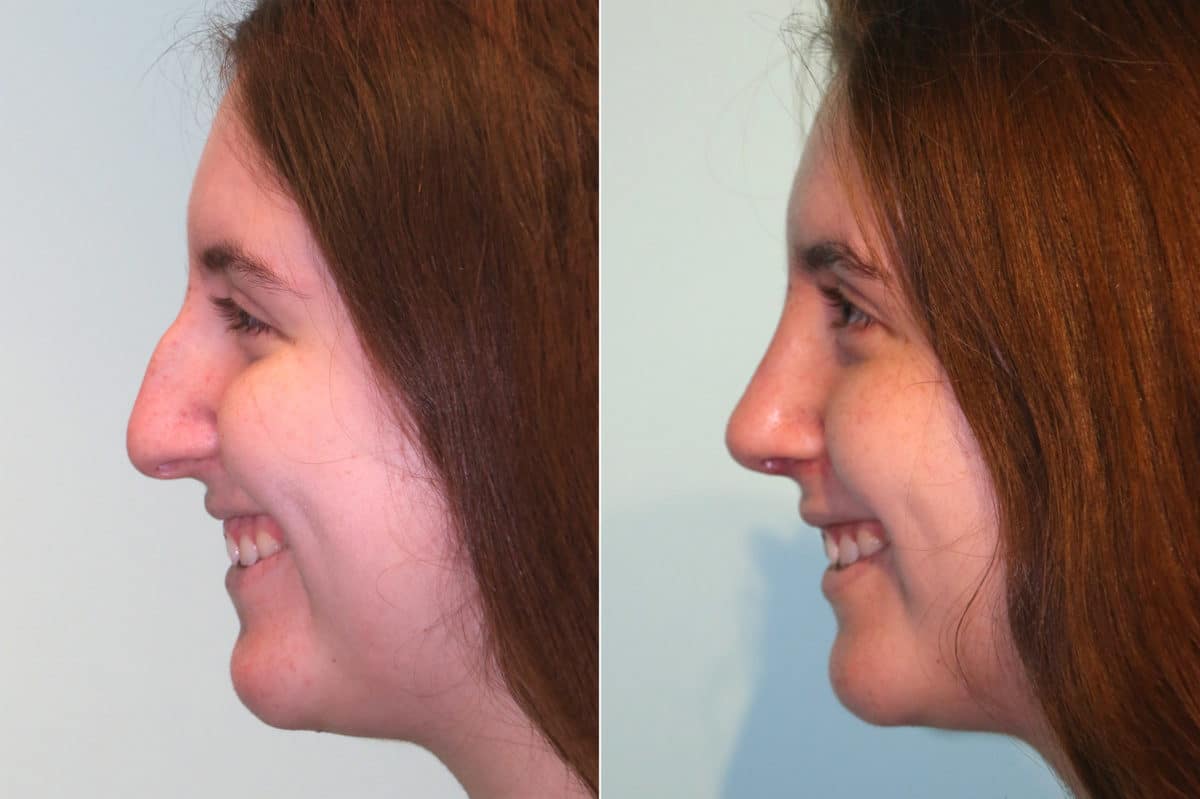 Before and after Rhinoplasty by Dr. Shervin Naderi, Patient 18958