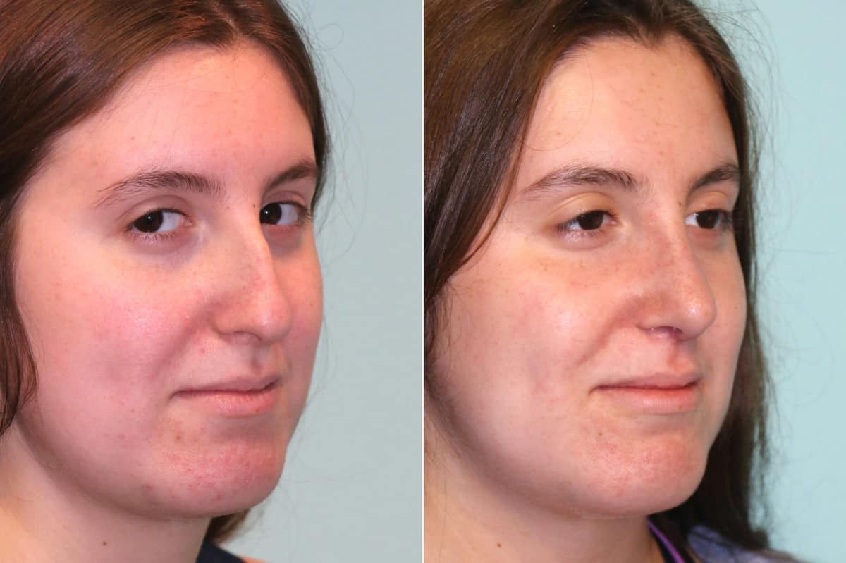 Before and after Rhinoplasty by Dr. Shervin Naderi, Patient 18958