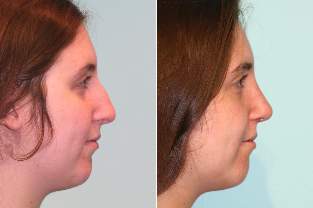 Before and after Rhinoplasty by Dr. Shervin Naderi, Patient 18958