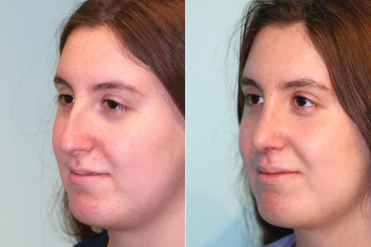 Before and after Rhinoplasty by Dr. Shervin Naderi, Patient 18958