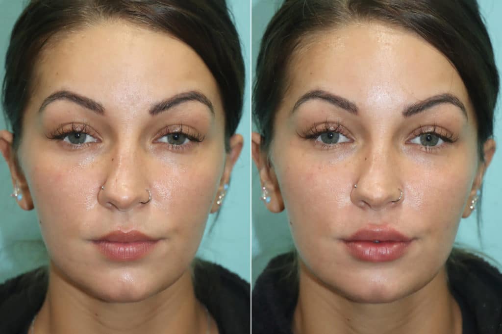 Injections, Lip Injections photos Chevy Chase, MD Patient 19027