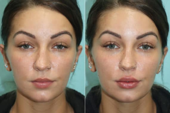 Before and after Injections by Dr. Shervin Naderi, Patient 19027