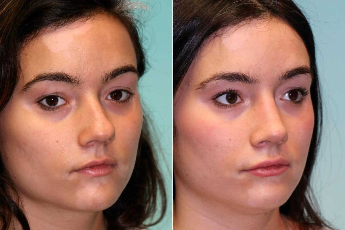 Before and after Rhinoplasty by Dr. Shervin Naderi, Patient 19061