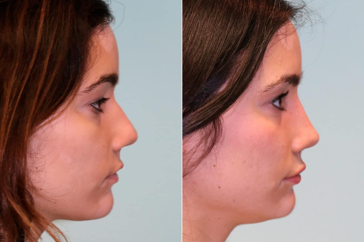 Before and after Rhinoplasty by Dr. Shervin Naderi, Patient 19061