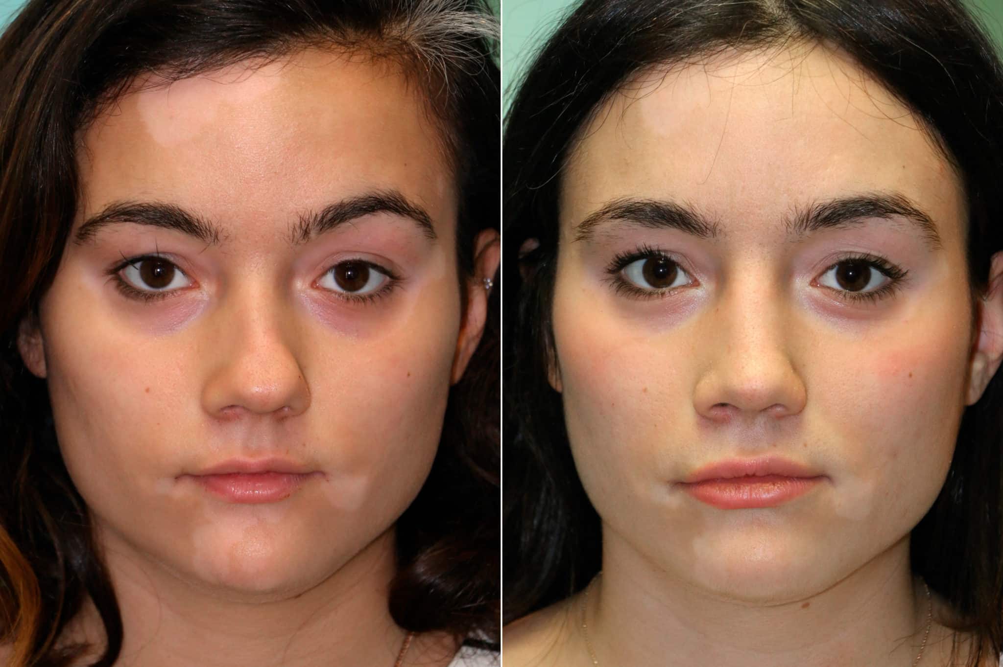 Rhinoplasty photos Chevy Chase, MD Patient 19061