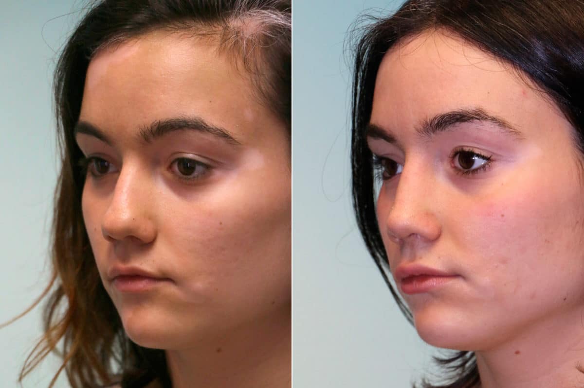 Before and after Rhinoplasty by Dr. Shervin Naderi, Patient 19061