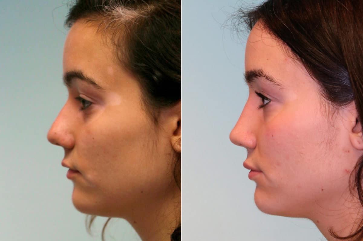 Before and after Rhinoplasty by Dr. Shervin Naderi, Patient 19061