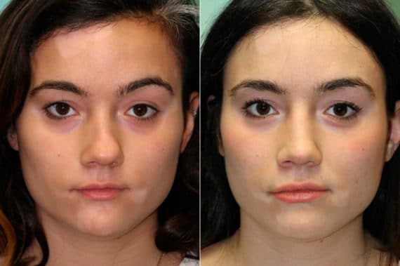 Before and after Rhinoplasty by Dr. Shervin Naderi, Patient 19061