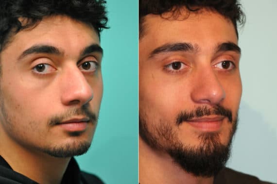 Before and after Rhinoplasty by Dr. Shervin Naderi, Patient 19132